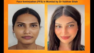 The Best results in Facial Feminization surgery in Mumbai [upl. by Silbahc]