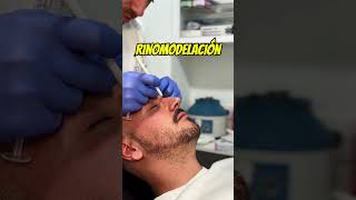 LA RINOPLASTIA ✨SIN CIRUGÍA✨ [upl. by Maximilien]