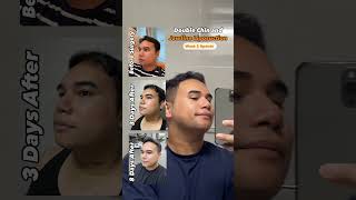 Week 2 update of my liposuction journey at 365mc liposuction LAMS weightloss [upl. by Huberman]