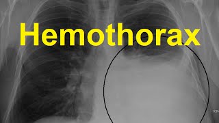 Hemothorax Symptoms Causes and Treatment [upl. by Ahsikyw]