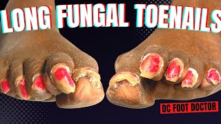 Long Fungal Toenails Trimming shaping cutting [upl. by Sedicla]