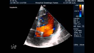 Miocardiopatia No compactada en varon de 43 anos Dr Pedro Guillermo Bustos [upl. by Hogan]