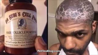 Dr Sebi team RESPONDS to Hair Follicle Product that BURNED Mans Scalp 👀😱💀 FINALLY [upl. by Eiramanig]