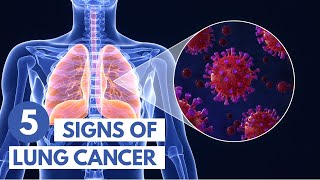 5 Signs of Lung Cancer  3D Animation [upl. by Hogle]