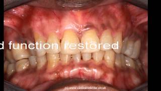 Generalised advanced teeth wear TSL restoration by Vaswani Dental at Southgate London N14 [upl. by Ecirahc520]