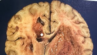 Glioblastoma Awareness Day and Brain Tumor Concept pathology glioblastoma surgery brain [upl. by Isbella]