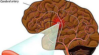 Intracerebral HemorrhageICHEtiology PathophysiologyClinical Features Diagnostic Treatment [upl. by Shelman]