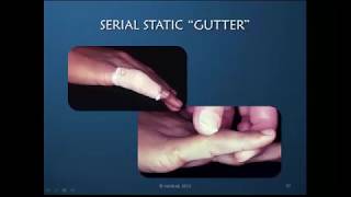 Obstinate PIP Joint Part 8 of 12 PIP StaticSerial Static Extension Orthosis Demonstration [upl. by Halverson]