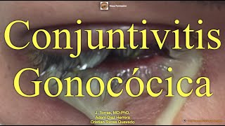 Conjuntivitis Gonocócica [upl. by Guod722]