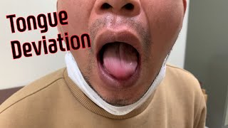 Tongue deviation  혀 삐뚤어짐 [upl. by Seth299]