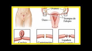 Laqueadura cirurgia para interrupção das trompas [upl. by Yntirb469]