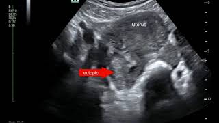 Ectopic Pregnancy Ultrasound Annotated JETem 2017 [upl. by Selemas]