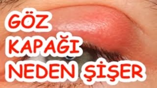 GÖZ KAPAĞI NEDEN ŞİŞER [upl. by Eicyac]