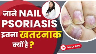 Nail Psoriasis का कारण  Nail Psoriasis ka Karan  Bharat Skin Clinic  Bharat Homeo Psoriasis Care [upl. by Ynahteb]