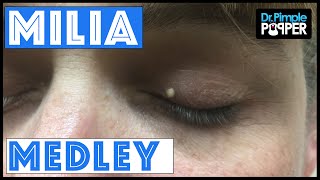 A Dr Pimple Popper Milia Medley [upl. by Alehs391]