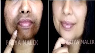 Remove Dark Black patches Dark Spots Around Your Mouth Get Rid Of Hyper Pigmentation  Priya Malik [upl. by Mun]