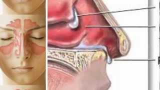 Nasal Polyps Treatment  Nasal Polyps Miracle Treatment™ [upl. by Ellennahs]