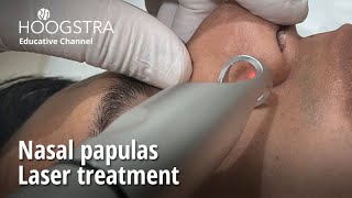 Nasal papulas  Laser treatment  23040 [upl. by Darrell]