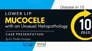 Mucocele of the lower lip A usual case with an unusual histopathologyOralPatholoygy360 [upl. by Einegue]