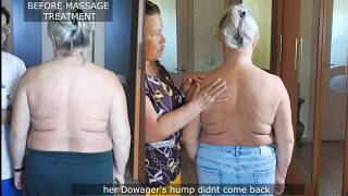 Dowagers hump and upper back massage with results before and after treatment [upl. by Avon]