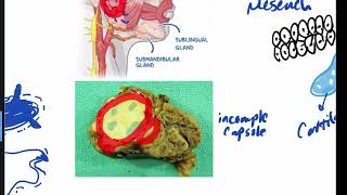 tumors of salivary glands [upl. by Thomey]