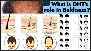 DHT Dihydrotestosterone What It Is Side Effects DHT How It Causes Hair Loss and How to Slow It [upl. by Wauters87]