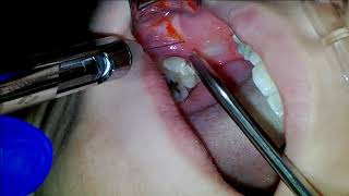 Luxator Removal of Mandibular Molar 31 [upl. by Ahtela]