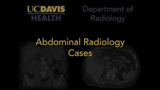 Hepatic steatosis MRI [upl. by Kavita]