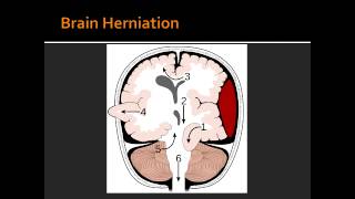 Intracranial Hemorrhage  Epidural Hematoma [upl. by Tol480]