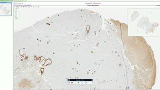 Cerebral Amyloid Angiopathy  Adventures in Neuropathology [upl. by Baudoin]