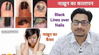 नाख़ून का कालापन  Black Lines on Nails  नाख़ून का कैंसर  Black Nails  Nail Cancer Melanoma nails [upl. by Liss27]