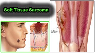 Soft Tissue Sarcoma What is Soft Tissue Sarcoma Symptoms And Treatment  Kaposi Sarcoma [upl. by Lilak]