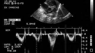 Pulmonary Stenosis [upl. by Mcmillan]