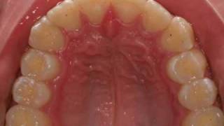 invisalign severe overjet [upl. by Utta]