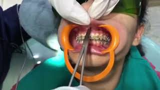 Laser assisted Frenectomy for an Ortho patient with Biolase 10 watt laser [upl. by Annoyed347]