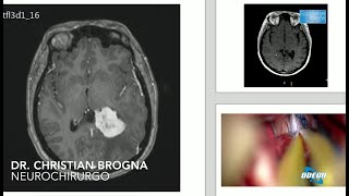 Meningioma intraventricolare  Dott Christian Brogna [upl. by Vogeley950]