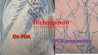 Trichosporon on SDA and LPCB preparation under the microscope [upl. by Mittel]