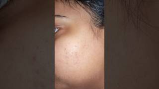 adapalene gelhow I used to cure my acne [upl. by Aenahs]