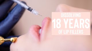 Dissolving 18 Years of Lip Fillers  The Vanity Lab [upl. by Marlo9]