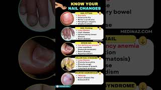 5 Nail Changes You Should NEVER Ignore  Nail signs of Disease nail nailhealth shortsfeed [upl. by Arikehs451]