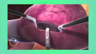 Atrial Septal Defect Repair at SSM Heart Institute [upl. by Ursal]