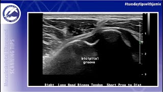 Biceps Tendon Rupture Shoulder Ultrasound Protocol [upl. by Adnilam]