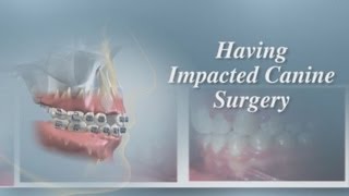 Having Impacted Canine Surgery [upl. by Yelsehc129]