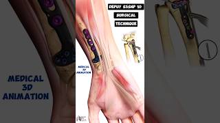 Depuy S3SNP 10 Surgical Technique Medical 3D Animation short biology With Aliya [upl. by Ennirroc]