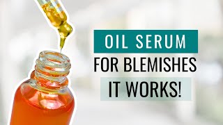 Get Rid of Blemishes with This Serum Formula  It Works [upl. by Ledua]