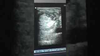 Hernia inguinal atascada  Ecografía [upl. by Oballa]