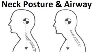 Chronic Cerebrospinal Venous insufficiency CCSVI Brendan Stack amp Craniofacial Dystrophy p2 [upl. by Bird694]