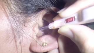 Massive Nasty Earwax Removal [upl. by Attiuqihc]