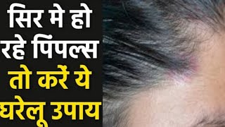 AcnePimples On Scalp How to treat Acne On Scalp स्कैल्प मुँहासे का इलाज कैसे करें  In HINDI [upl. by Carina]