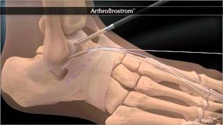 Bandrekonstruktion bei chronischer Instabilität des Sprunggelenkes  Arthroscopic Broström [upl. by Anilem]